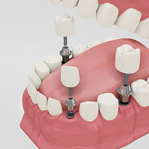 Implantes dentales